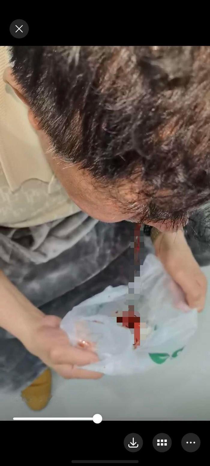 “必须严查！”山东青岛，一66岁老人花35000元，种了6颗牙，种完后呕血，出血