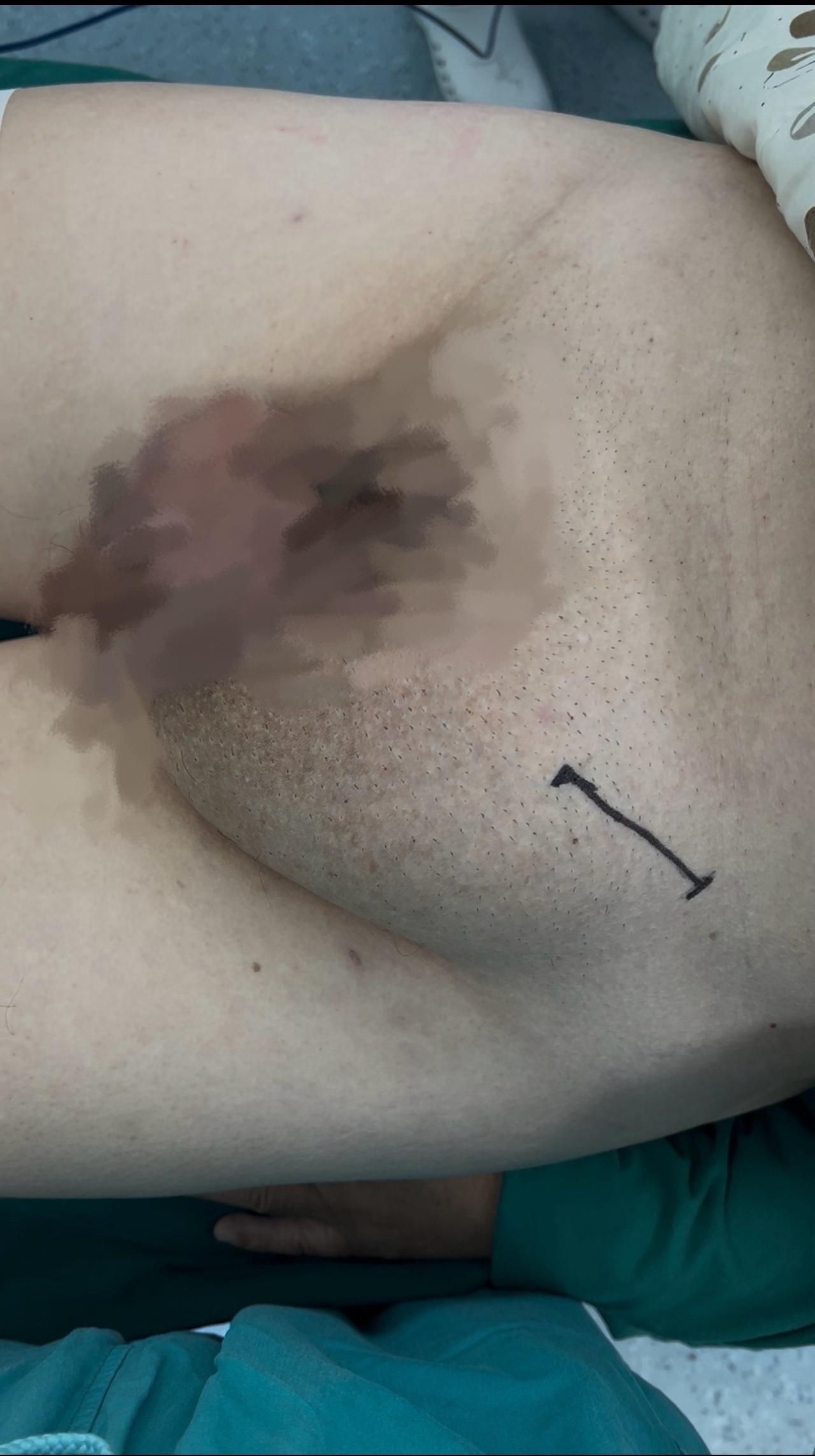 巨大的腹股沟疝，肠子掉出来了，清醒状态下，无法回纳。全麻以后，患者肌肉松弛了，被