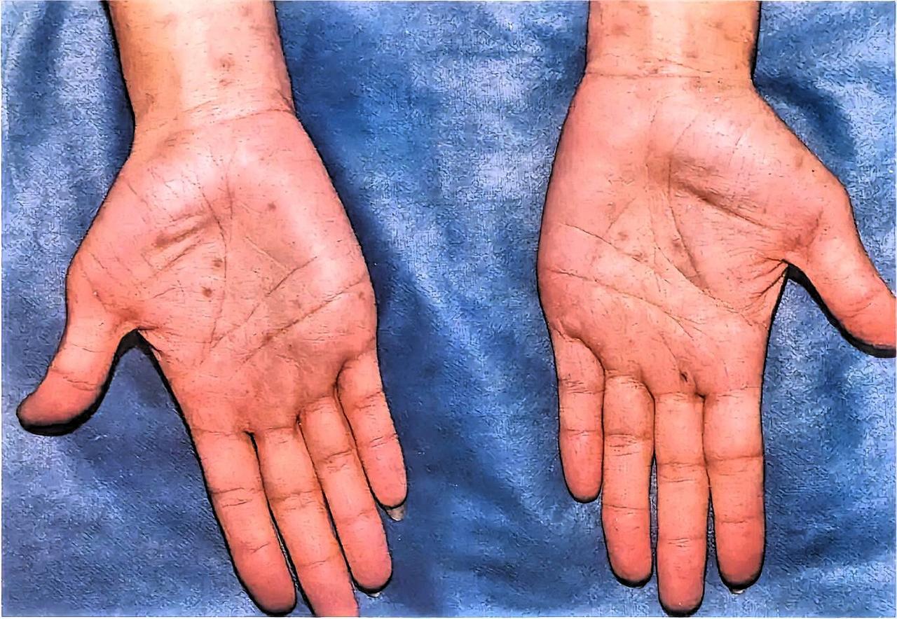 日本梅毒感染情况令人担忧。最新数据显示，日本梅毒确诊病例已连续 4 年突破 1.