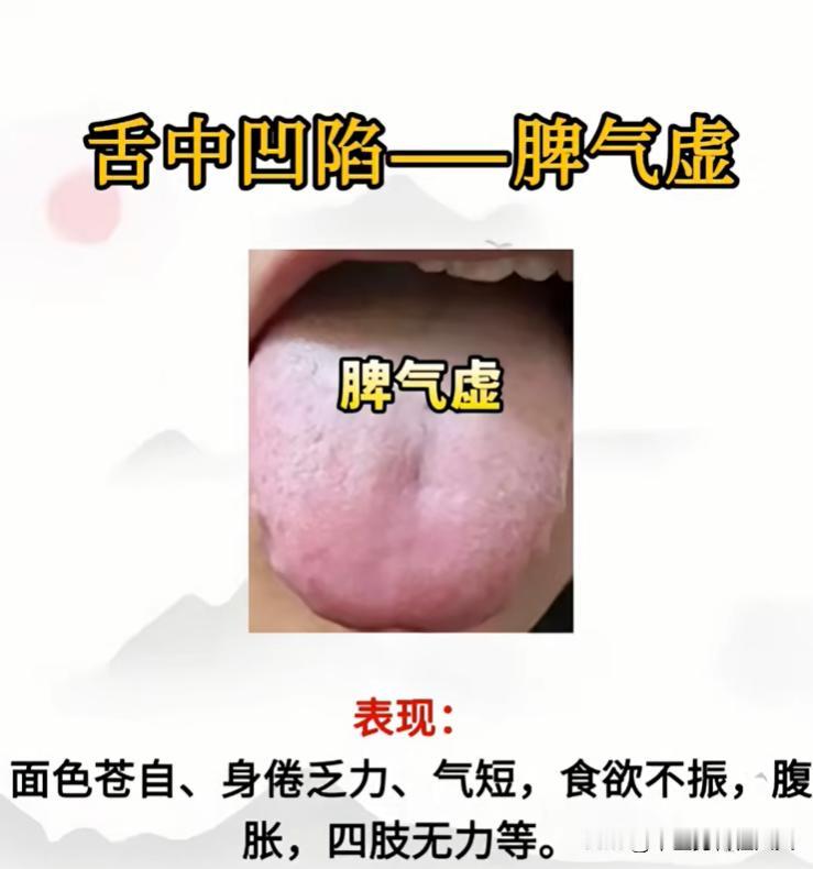 四种脾虚舌象对照自查，看看你属于哪一种