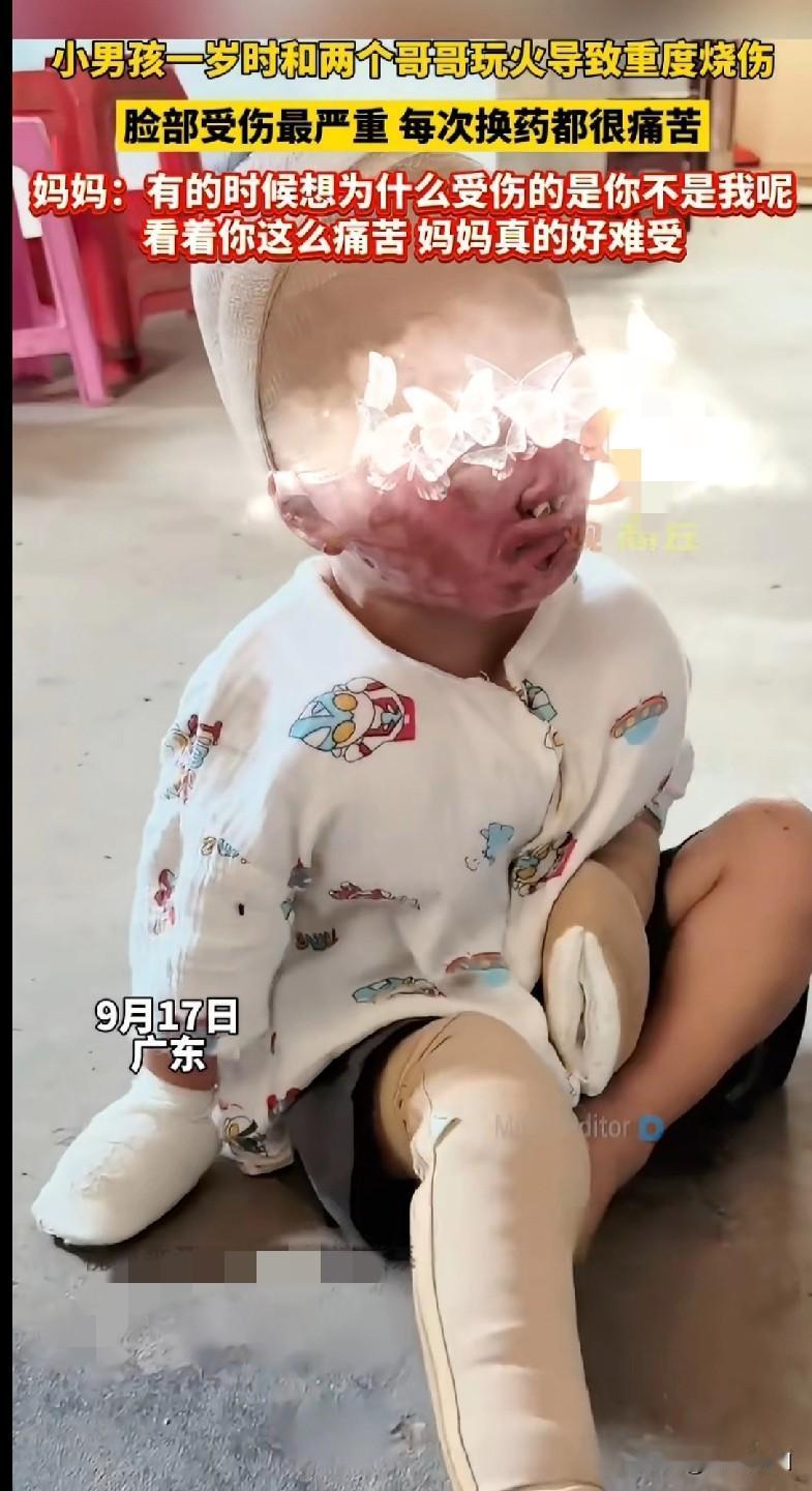 看着好心疼，好吓人啊！“家人们看完真的破大防了！广东这个小男孩一岁时和哥哥玩火，