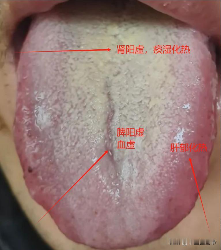 看见这样的舌头，舌苔又黄又腻，你是不是以为是肝胆湿热，但如果你用龙胆泻肝丸，只会