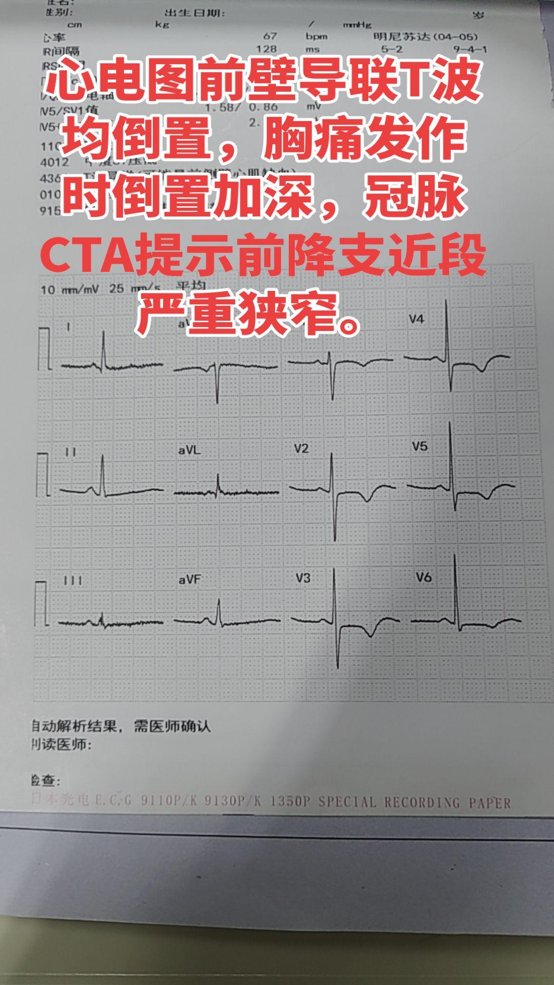 我的日常 心电图