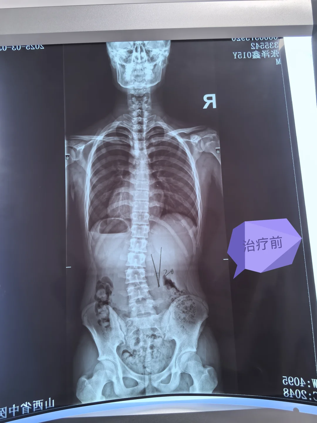 青少年脊柱侧弯中医保守治疗