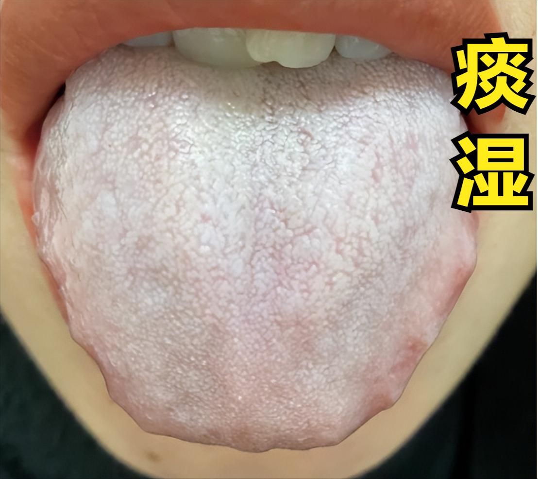 痰湿重人困，寒湿重手脚凉，湿热重口臭，三招教你调

一、痰湿重人困
① 原因：脾