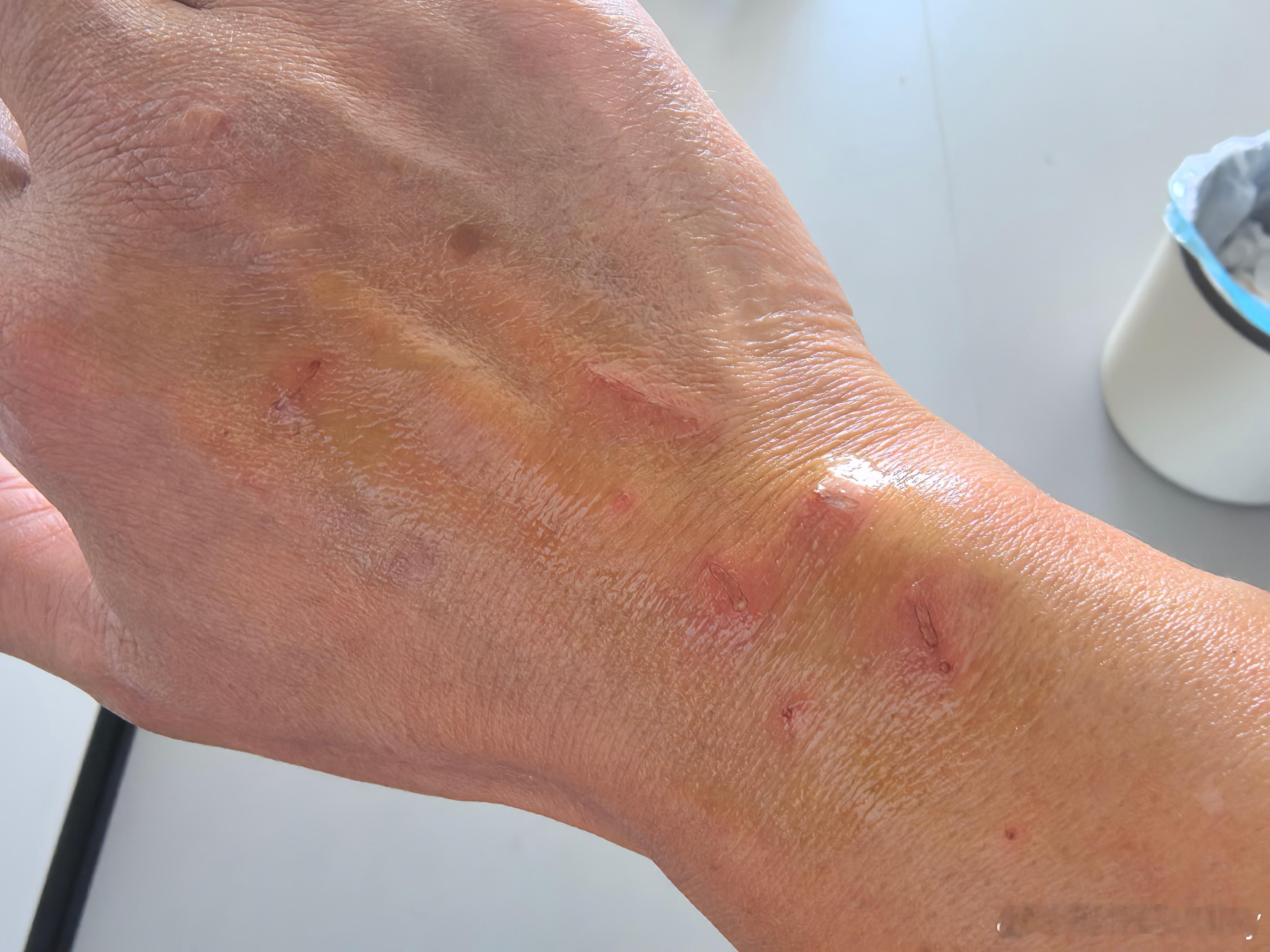 都两天了，还这么痛😣，小拇指还是肿的。家有萌宠