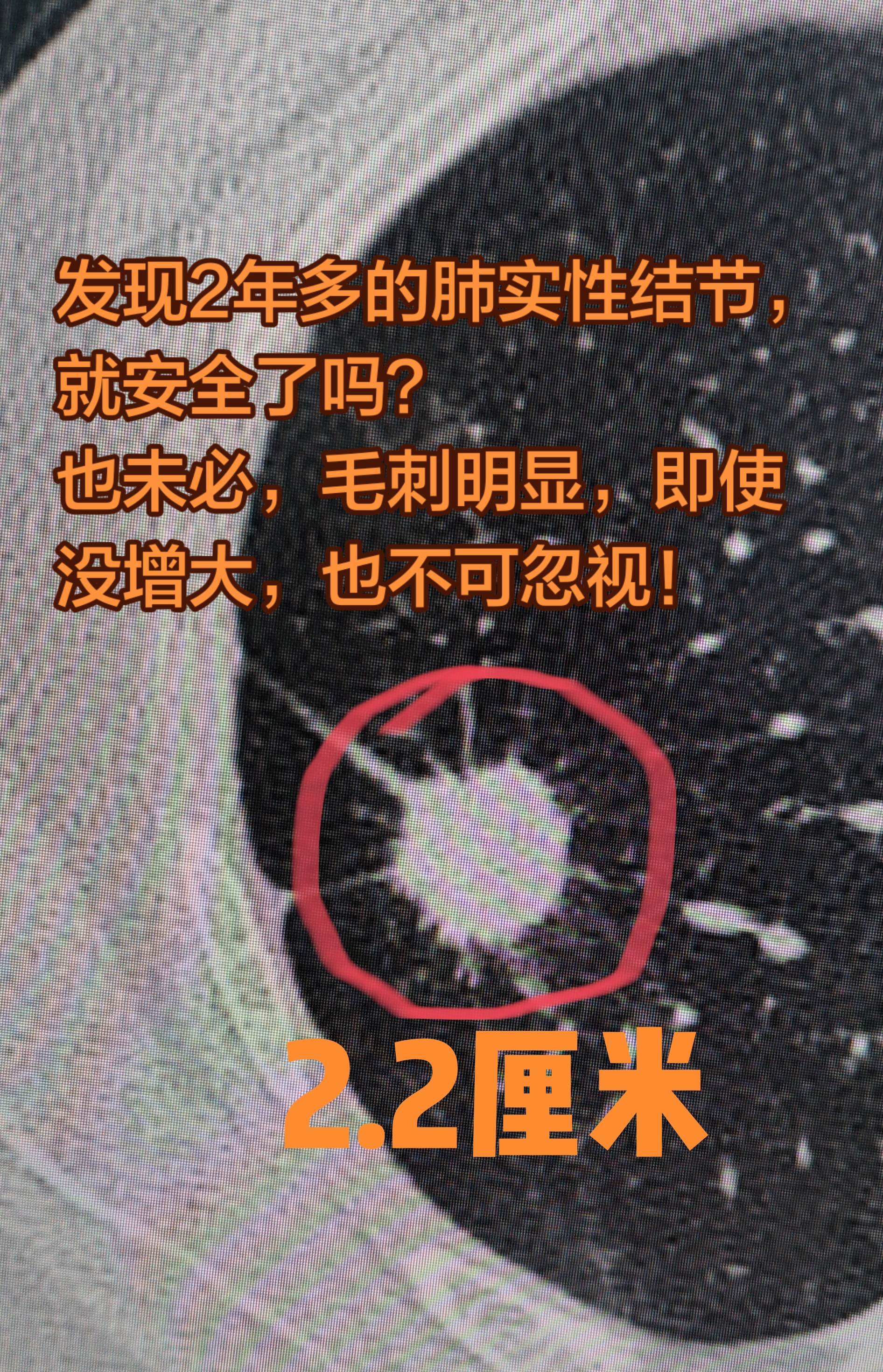 肺实性结节与高危肺结节。发现肺结节2年多了，考虑肺癌，外院行气管镜检查...