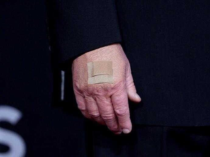 【特朗普回应手上瘀伤】特朗普承认服用阿司匹林 79岁的美国总统特朗普日前接受美媒