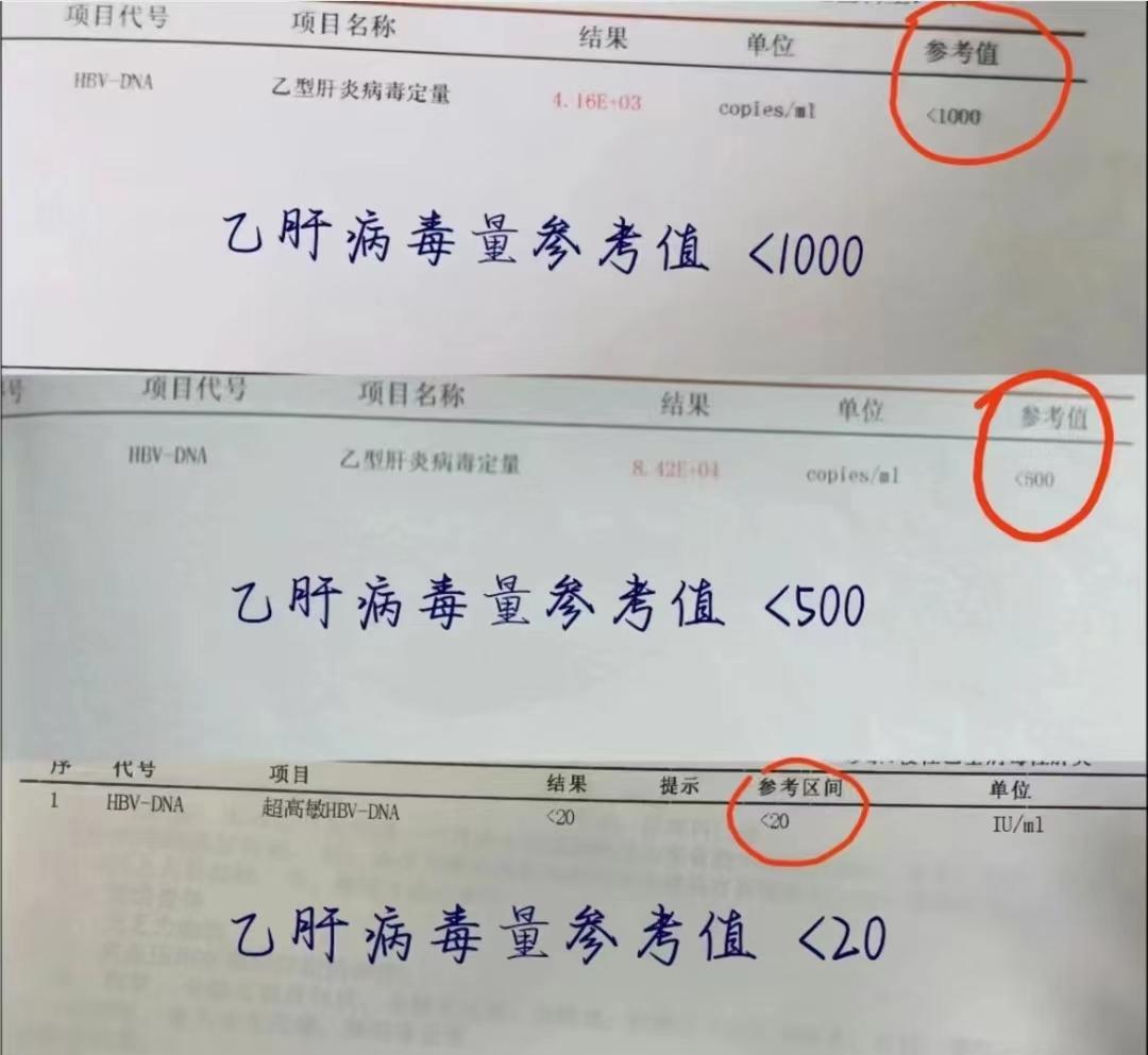 病毒量低于这个数才是安全的。过去很多患者以为病毒控制在500以下就是安...