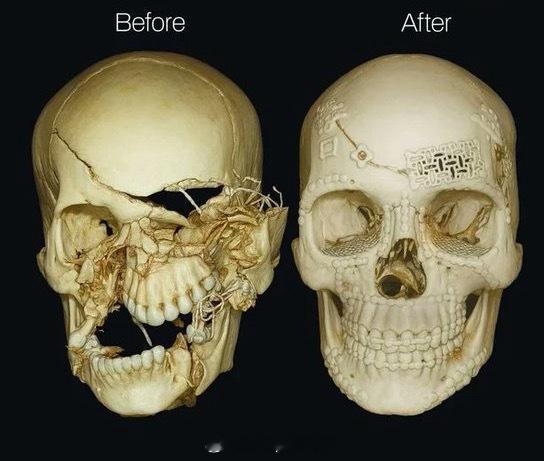兵器影像 事故造成的颅骨骨折手术修复前后对比。 