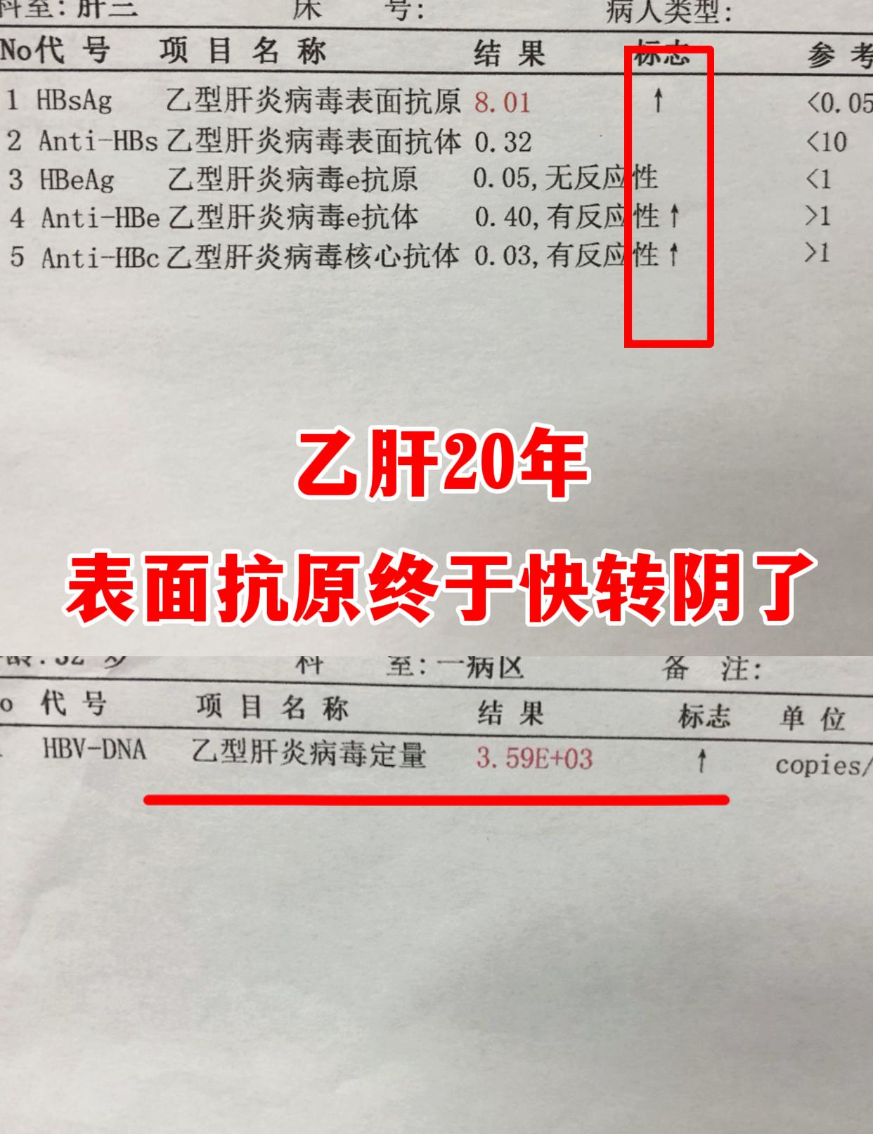 今天门诊太让人欣慰了！济南一位病友复查，乙肝整整 20 年，表面抗原降...