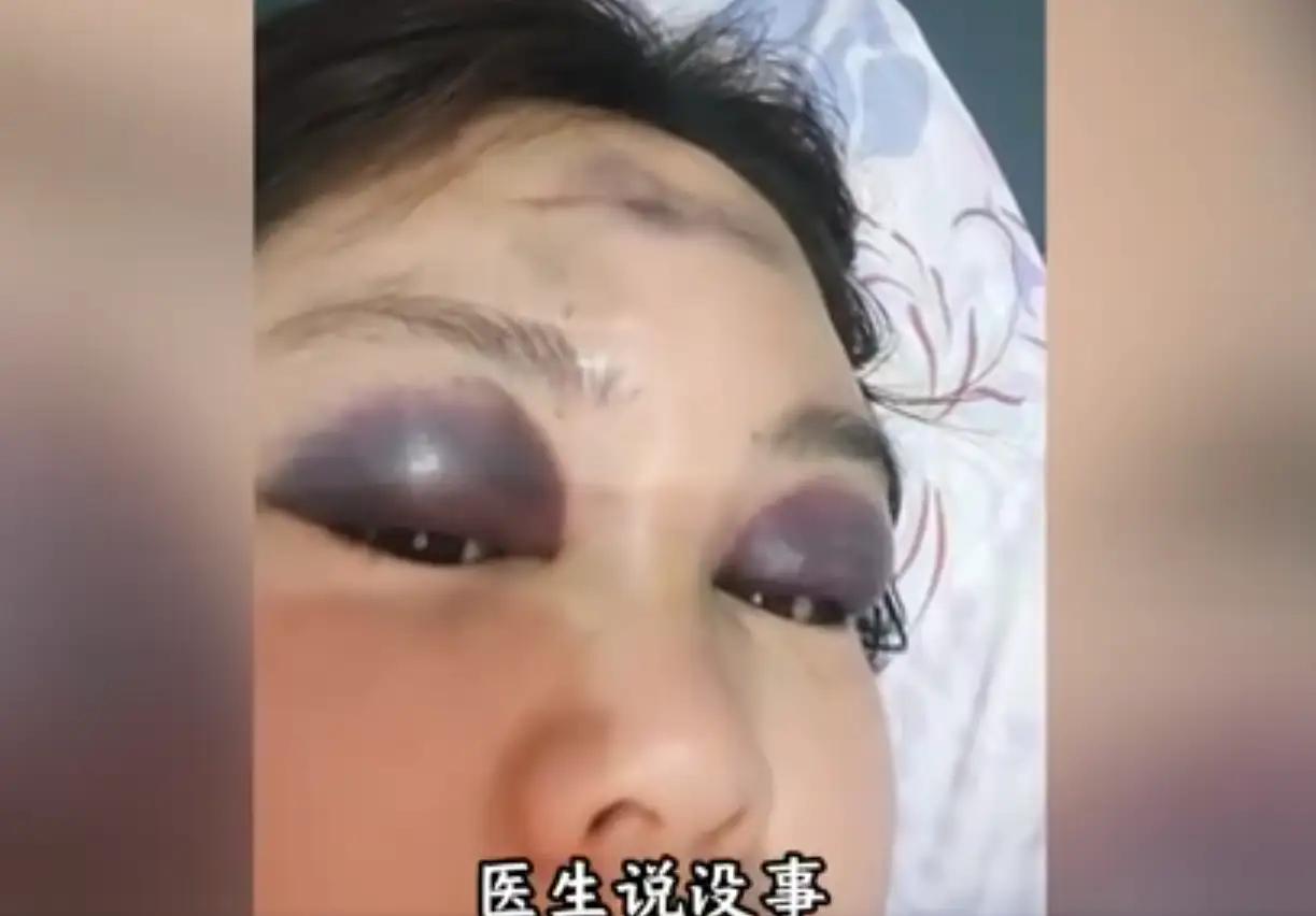 广东汕头，一对夫妻在床上打闹，没成想，一时力度太大失控，女子直接撞到床头上，眼部