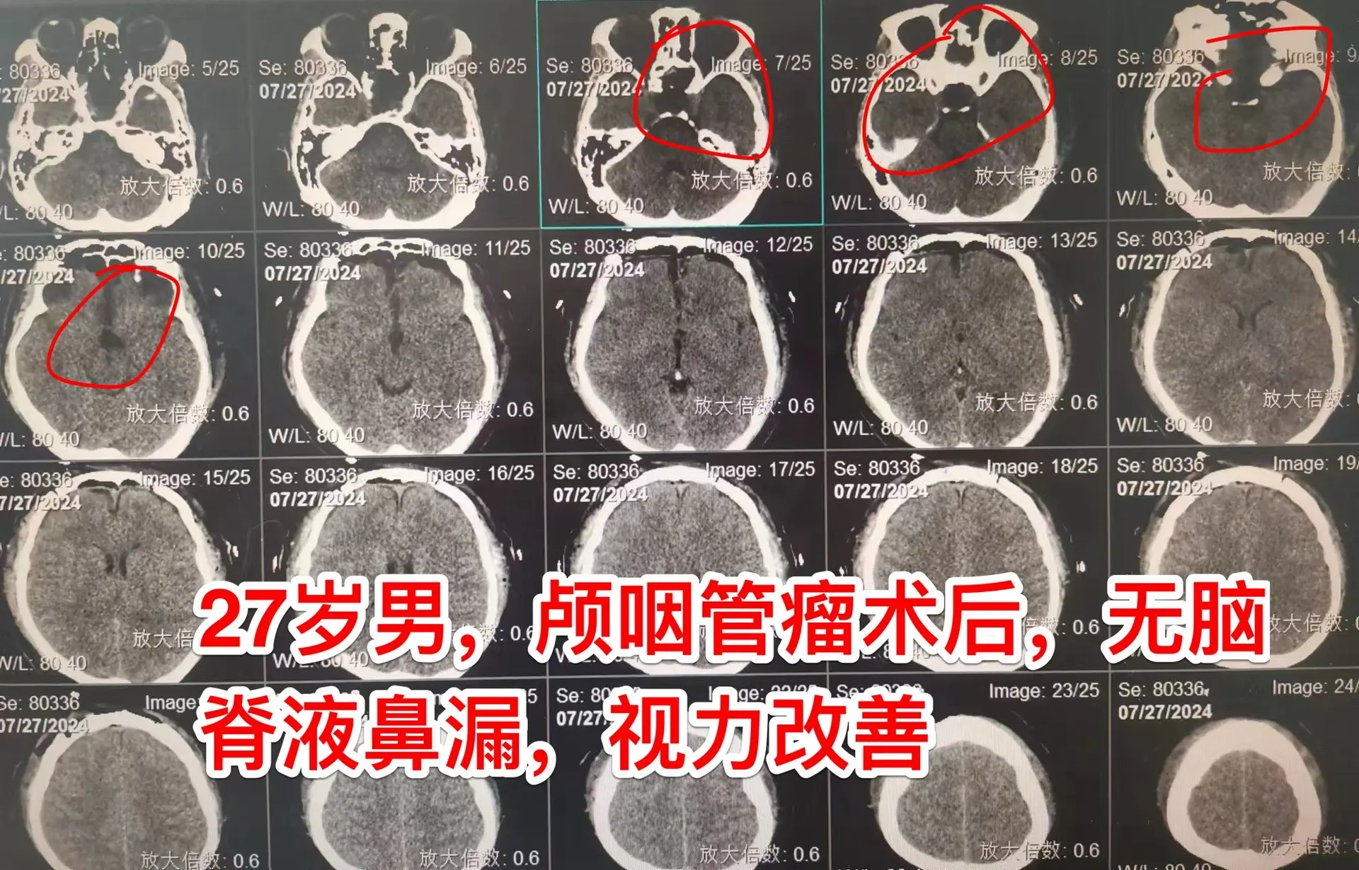 颅咽管瘤经鼻手术后8个月复发视力严重受损。27岁的甘肃小伙子因视力下降...