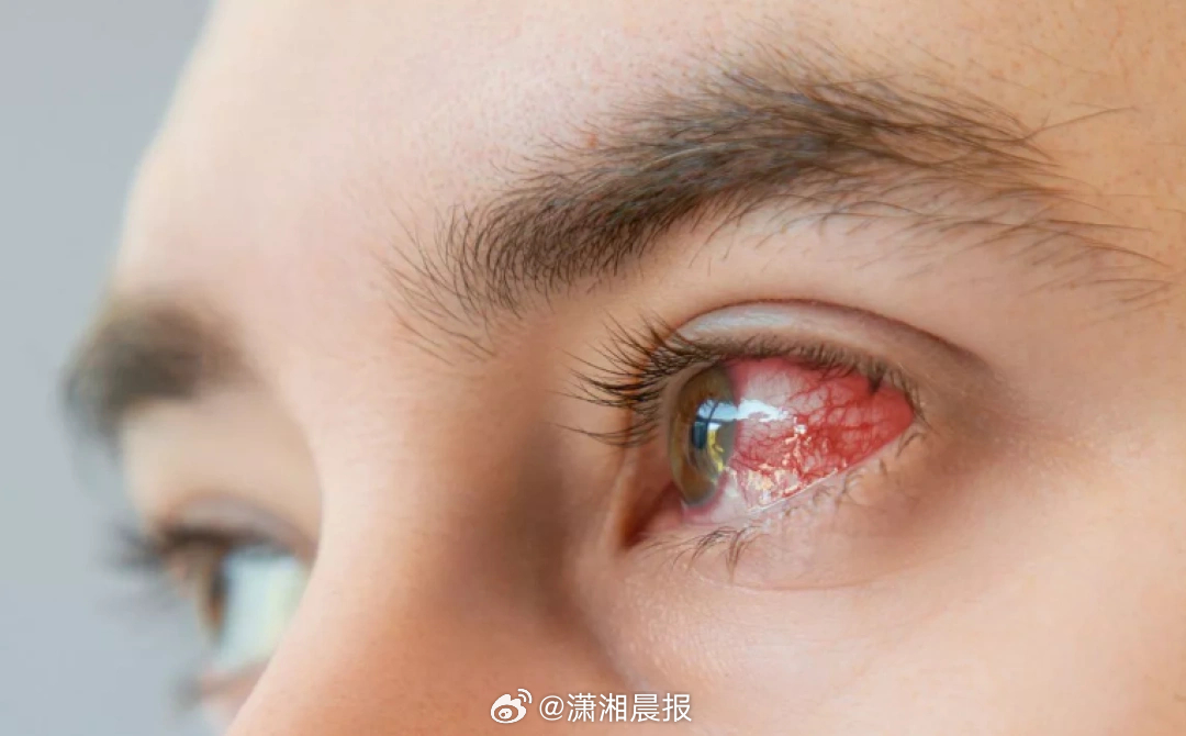 【19岁#女孩戴隐形洗澡感染寄生虫或将失明##女孩回应戴隐形眼镜洗澡感染寄生虫#