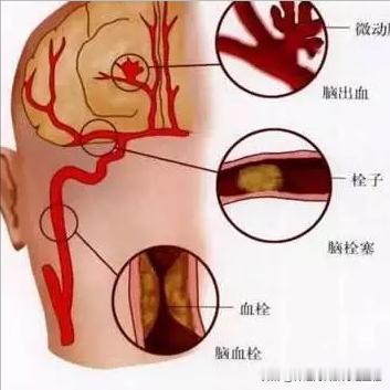 战胜脑梗不是梦！3阶段科学把握
 
1. 脑梗塞没发生之前
在脑梗还没发生时，预