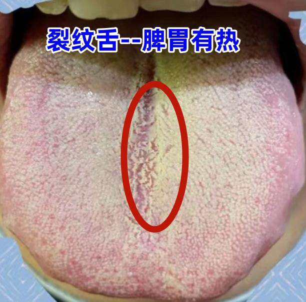 舌中裂纹越重，寿命越短！4大常见裂纹舌，一次给你讲明白！[谢谢][谢谢][谢谢]