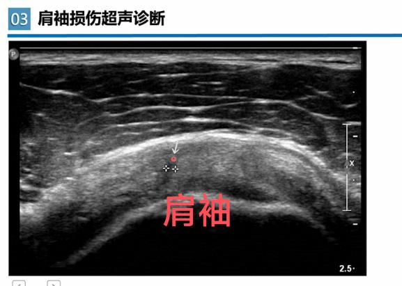 肩袖超声。