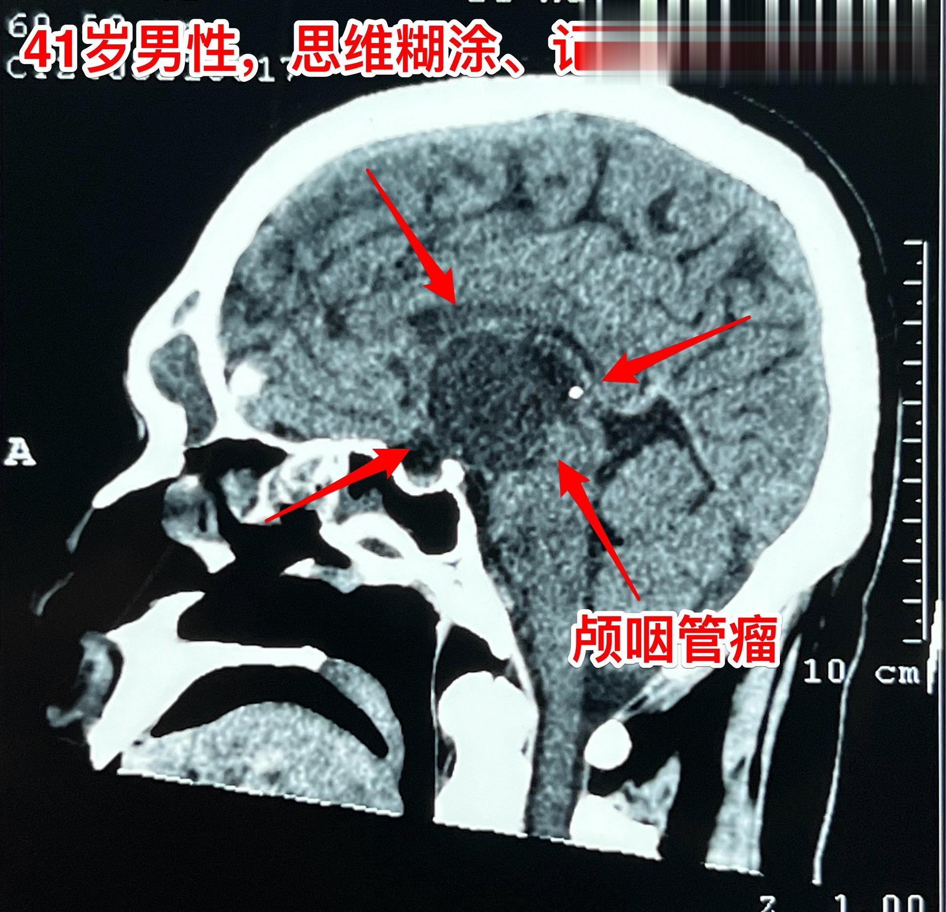 5月31日的颅咽管瘤手术。41岁山西男性，因思维糊涂、记忆力差发现鞍区肿瘤，为乳头型颅咽管瘤。
        常规的经额底纵裂入路，将肿瘤完全切除。手术后病人的精神状态很好。
        五月份的一共完成21台手术，其中20台为颅咽管瘤（今年一共80个颅咽管瘤手术），另一台为鞍区皮样囊肿！
        在神经外科界，鞍区肿瘤的治疗是很有挑战性的！[呲牙