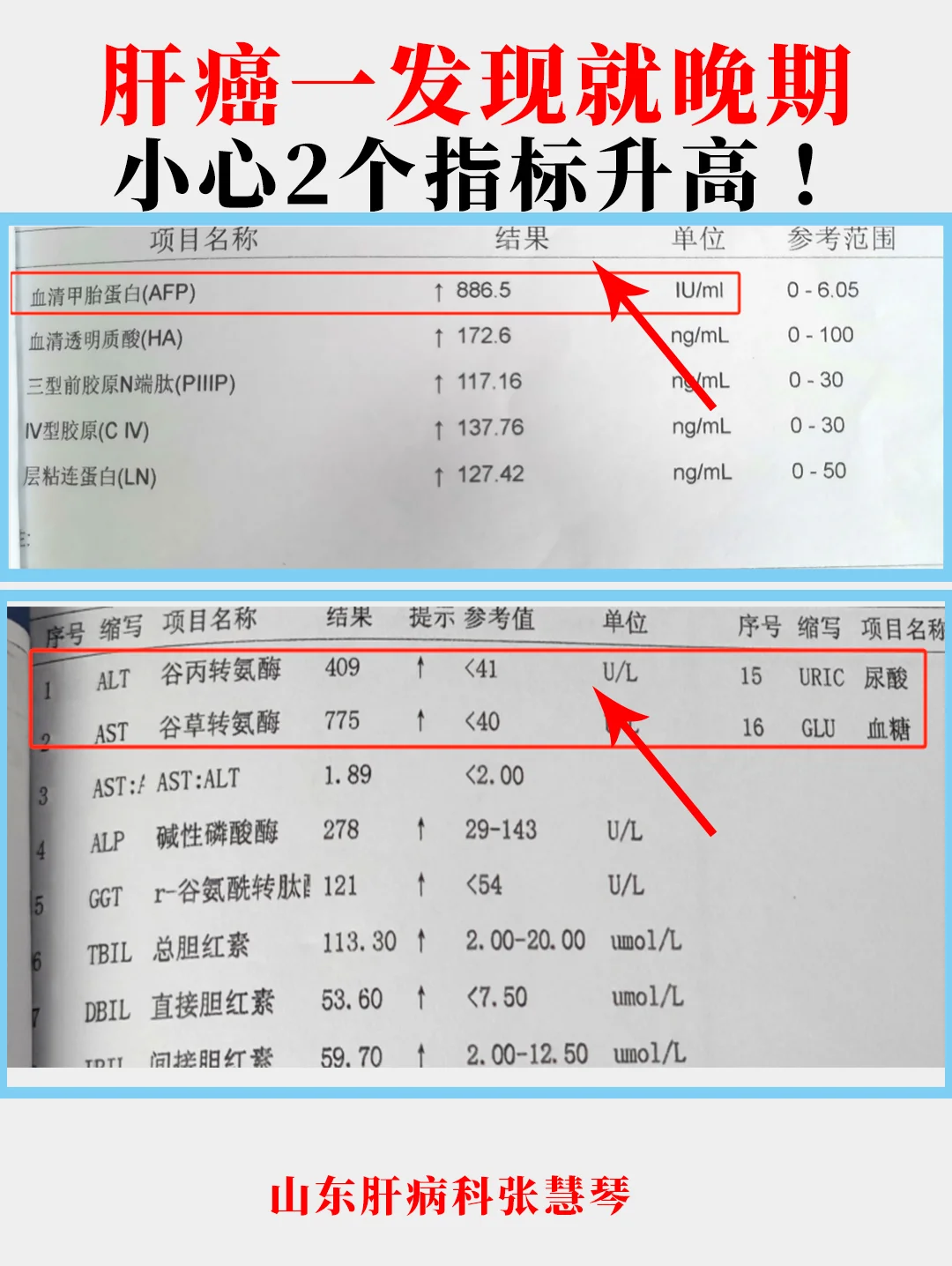 肝癌一发现就是晚期，小心2个指标升高！