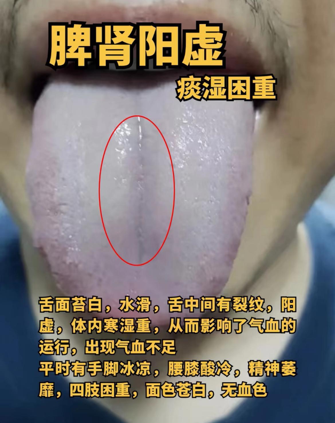挑战舌诊分析一个月，第16天！今天不忙，专门抽出时间，来进行统一回复

舌诊拍摄