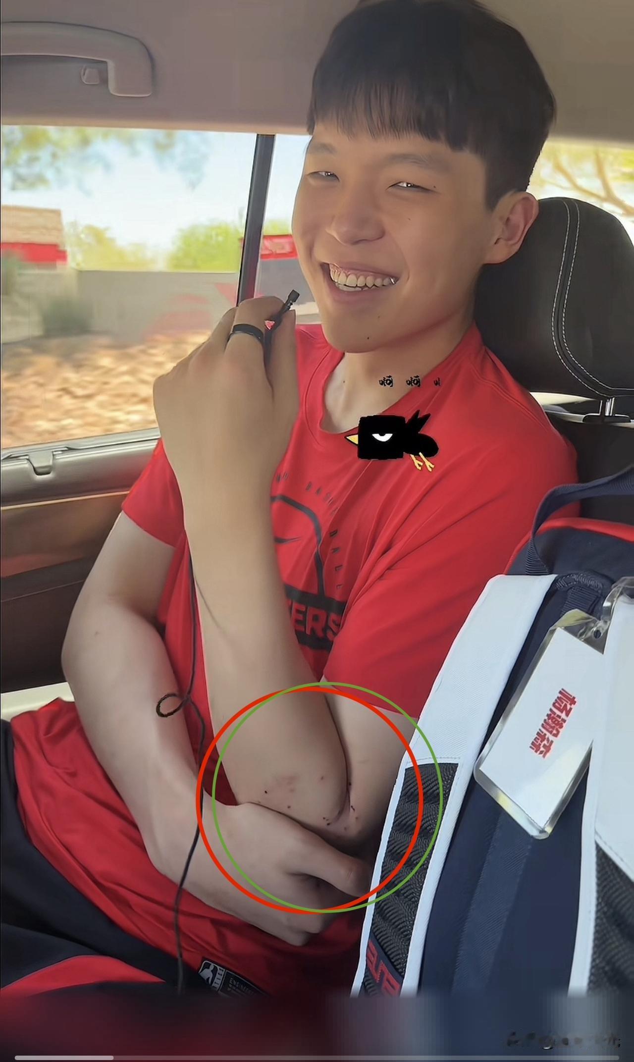 杨瀚森肘部湿疹明显！
看小杨的手肘位置，明显是疲劳和精神双重压力导致的结果，小伙