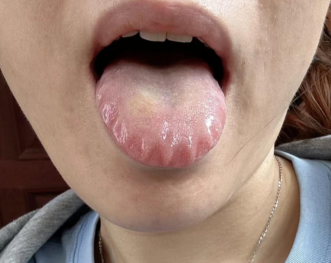 一模一样的舌头可真不少！这个齿痕有点狠啊[震惊]
门诊里许多患者，只要发现，自己