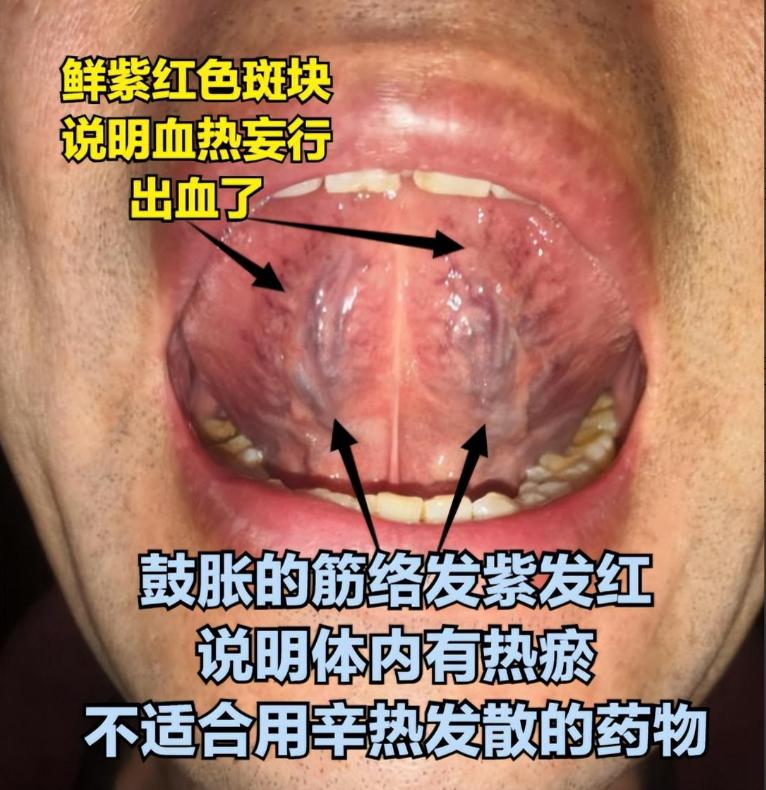 血瘀也分寒热，不是所有的血瘀，都适合用血府逐瘀丸，以下3种情况记得分清！[谢谢]