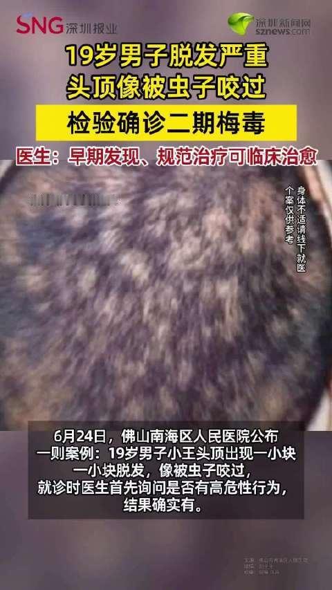 [汗]“这就是不自爱的下场！”广东佛山，19岁小伙头顶突然一小块一小块脱发，像被