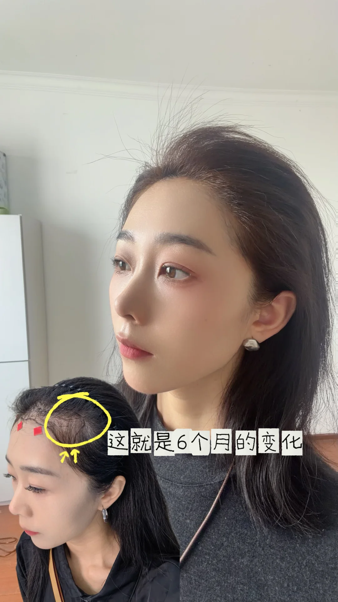 让脸变小的秘密找到了！发际线重塑记录