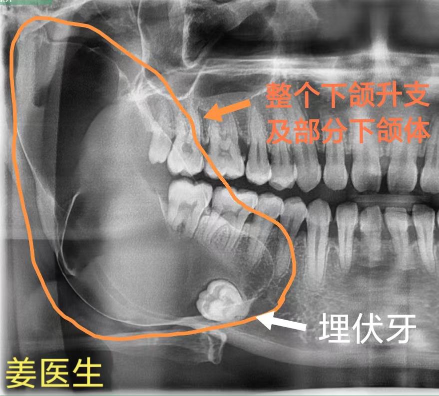 巨大下颌骨囊肿。巨大下颌骨囊肿，累及整个右侧下颌升支及部分下颌骨体，仅...