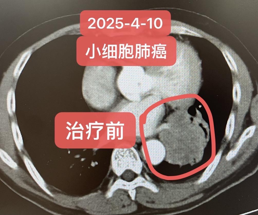 局部晚期小细胞肺癌的综合治疗。患者男，56岁，病理活检：小细胞肺癌（神...