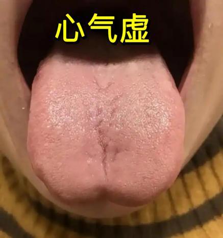 今日分享：六大心虚舌象，看看你是哪一种？

1. 心气虚
典型舌象：舌尖中央凹陷
