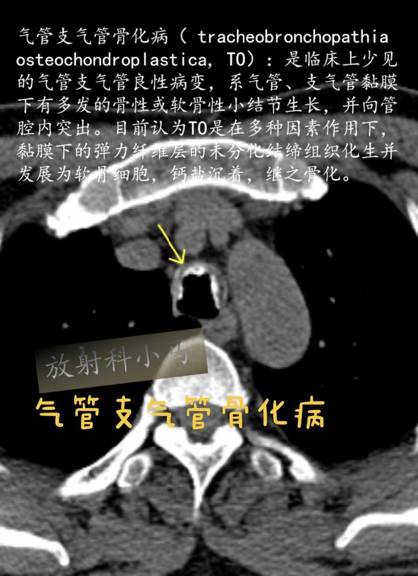 气管支气管骨化病（ tracheobronchopathia oste...