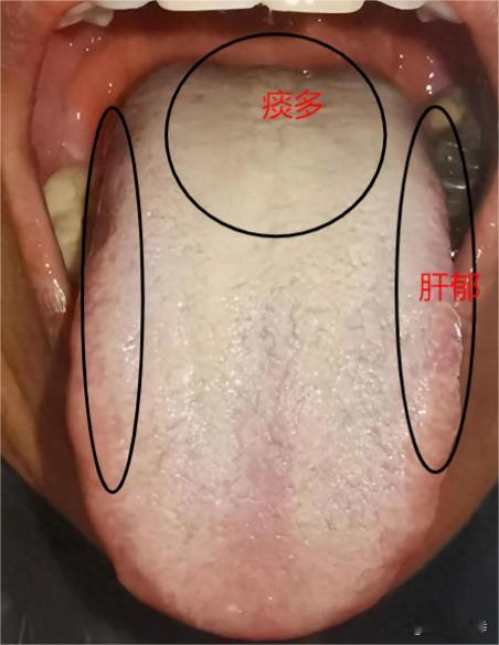 这种舌头，舌苔又厚又腻，痰湿重，但是吃再多二陈丸也没效果
患者主诉：咳嗽，断断续