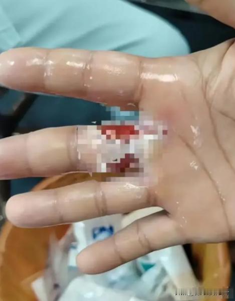 现实版"化骨水"！深圳女子称沾染"化骨水"，手指严重受伤，专家：可以透过皮肤腐蚀