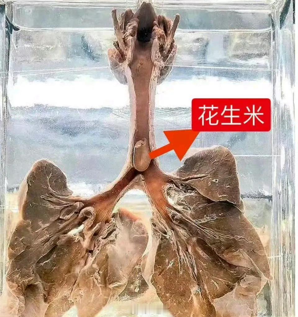 被花生米噎死的解剖照片，主气道异物非常危险，需要及时就近医院治疗 ​