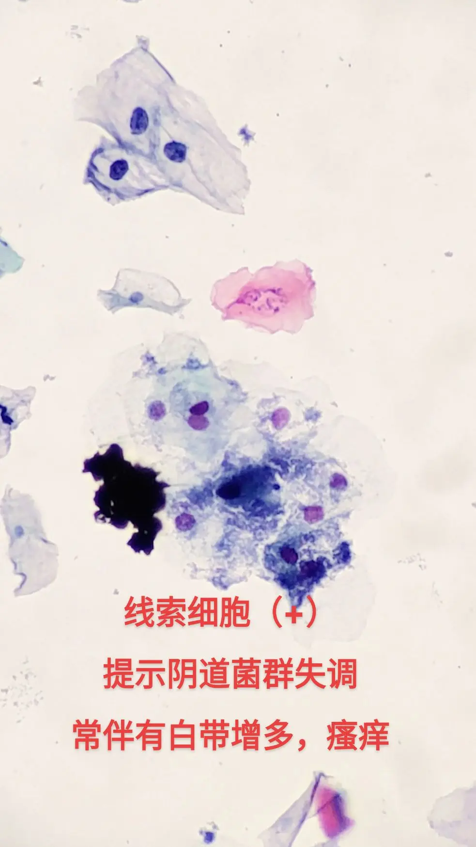 线索细胞  阴道瘙痒