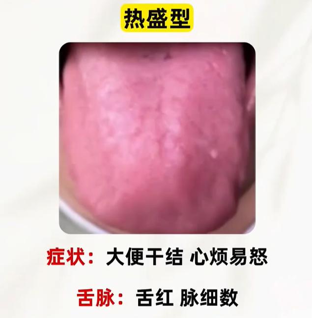 中医舌诊科普：5 种体质舌象、体征对照全解析