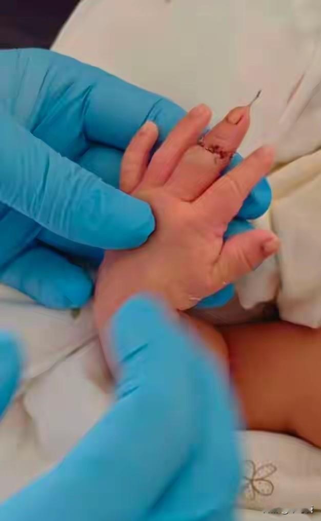 刚出生的孩子，被医生剪断脐带误剪掉手指，换谁家属也不能接受啊。近日江苏省盱眙县人