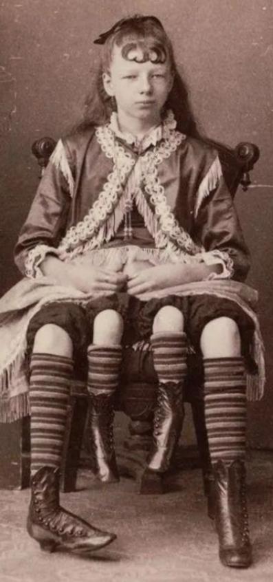 [中国赞]上世纪60年代，美国一个长着四条腿和两个生殖器官的女孩，被父亲高价卖给