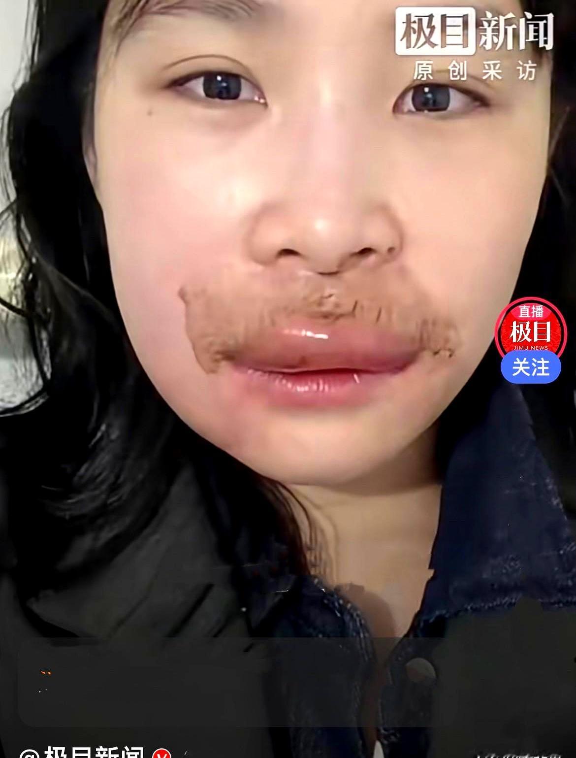 巴中这姑娘，婚礼头两天被马蜂对着嘴来了一口，十分钟肿成“香肠”，连夜又是针又是药