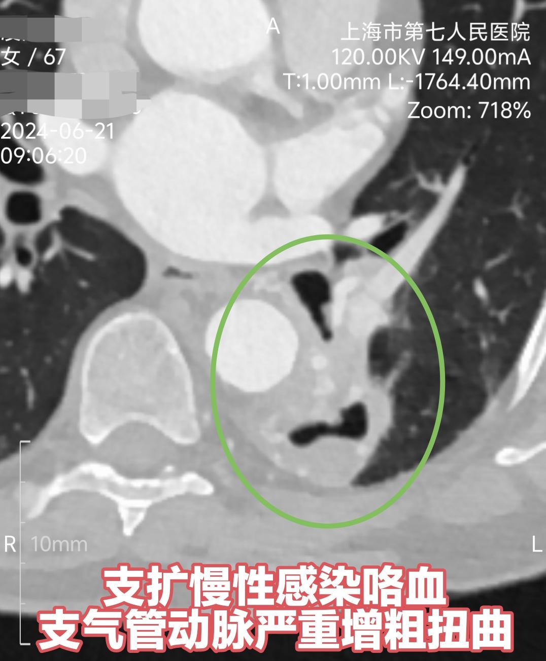 支扩长期感染伴咯血，手术绝非轻松，粗大曲张血管满布，触之出血，也是BP...