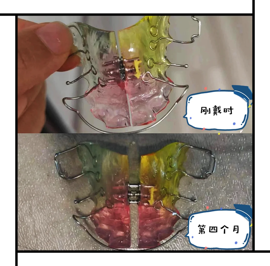 娃扩弓四个月效果明显