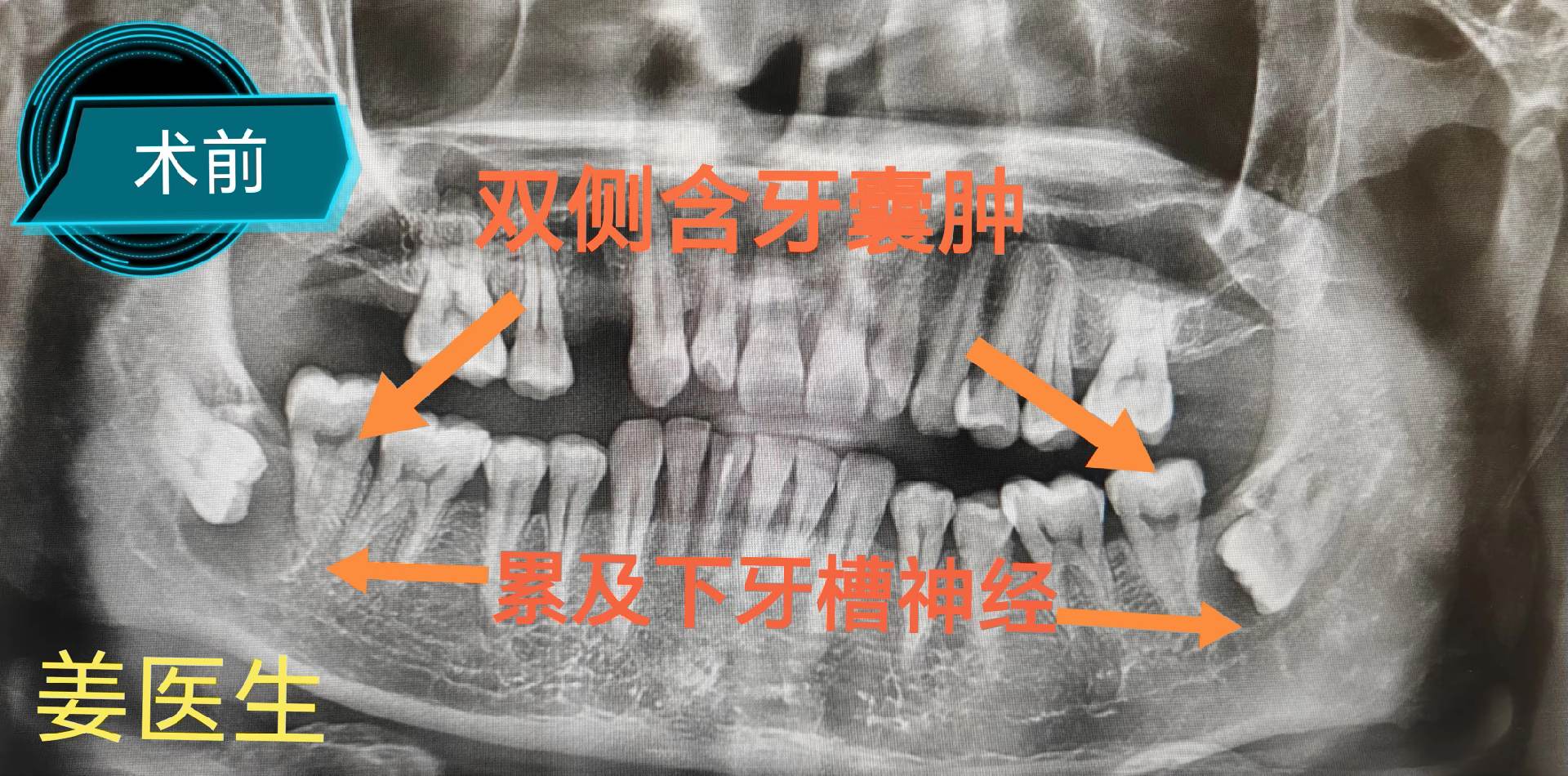 含牙囊肿。双侧智齿含牙囊肿，紧贴神经，分次局麻下拔除智齿，将囊肿完整刮除。术后无下唇麻木症状。