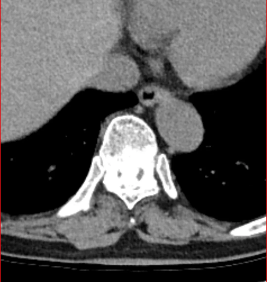 胸椎管狭窄微创