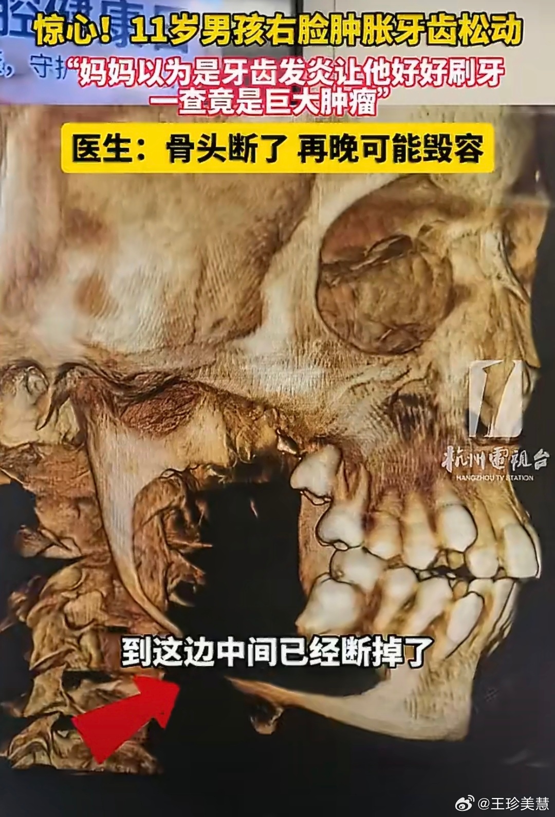 11岁男孩脸肿竟是肿瘤骨头断了我的天啊如果小孩子脸两侧肿了一定要去检查大多数家长