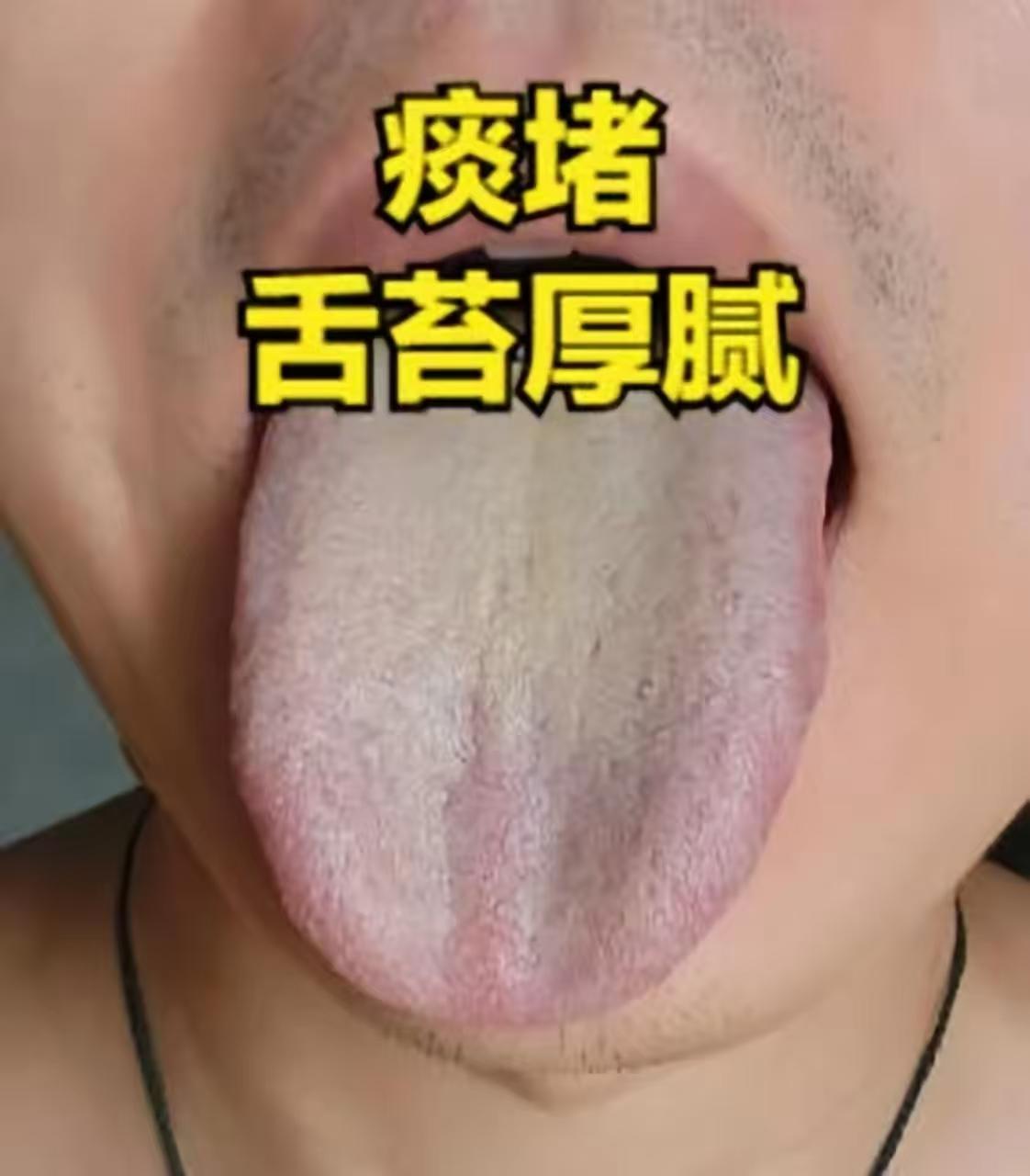 男人最怕的三种舌象：肝郁、血瘀、痰湿舌！

男人的健康问题，往往能从舌头上看出端