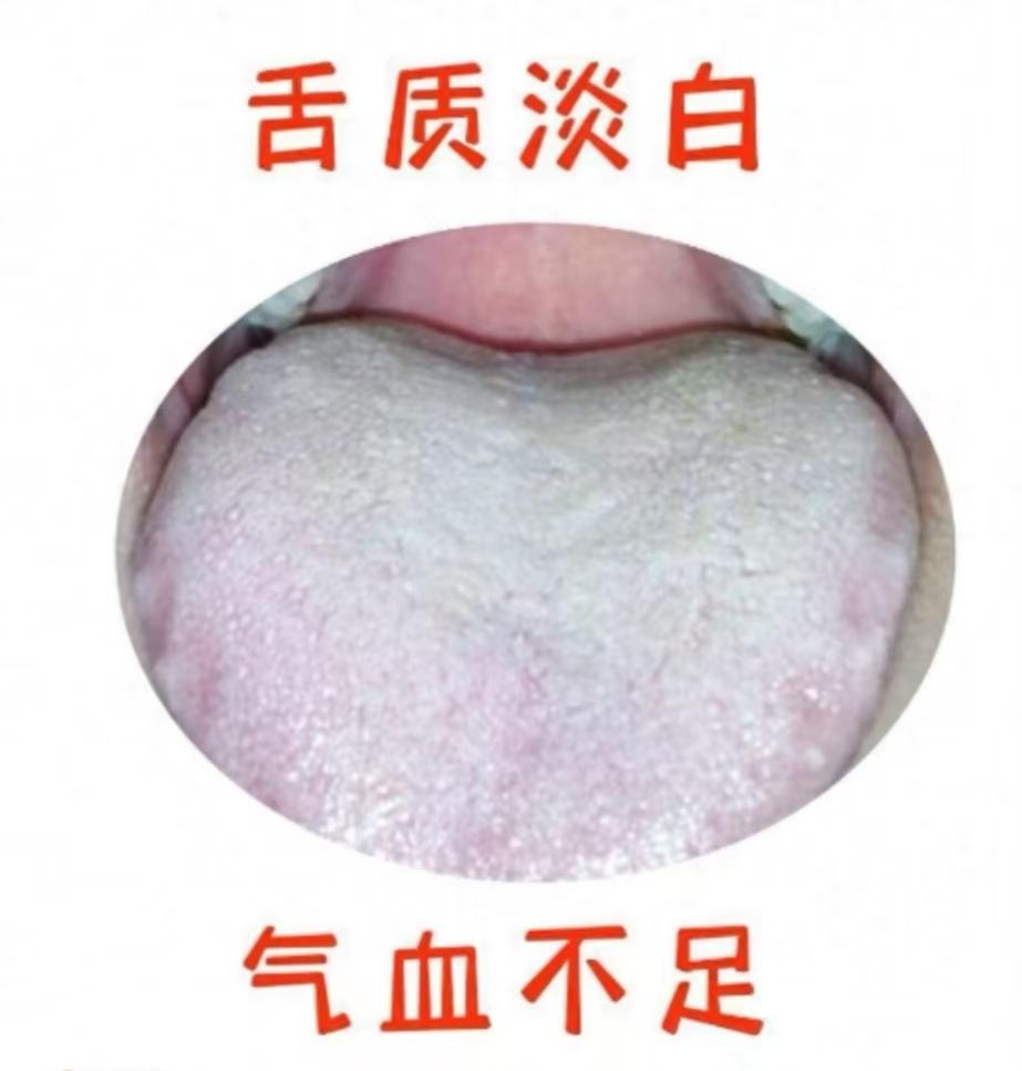 “血虚百病齐”，6种常出现的气血亏舌象，健康危机早发现！
 
血虚，通常讲，则是