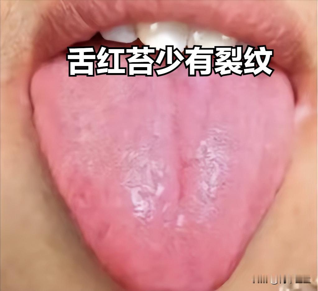 你的舌头有以下几个表现，说明是你的身体在预警

舌红少苔有裂纹
舌面上出现各式各