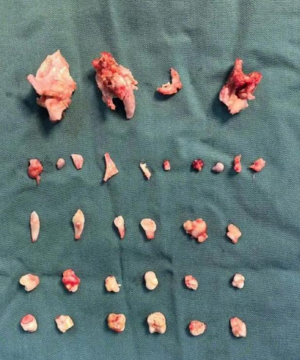 湖南长沙一位18岁女孩曾琳琳，前段时间在家跳操，跳着跳着右下腹突然开始剧烈疼痛，